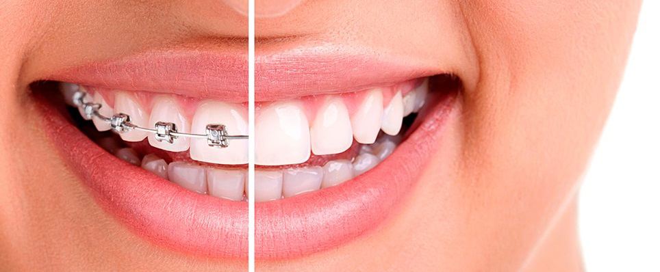 Limpieza de los Brackets