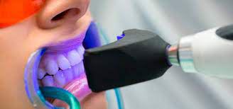 Protocolo de blanqueamiento de diente dental no vital