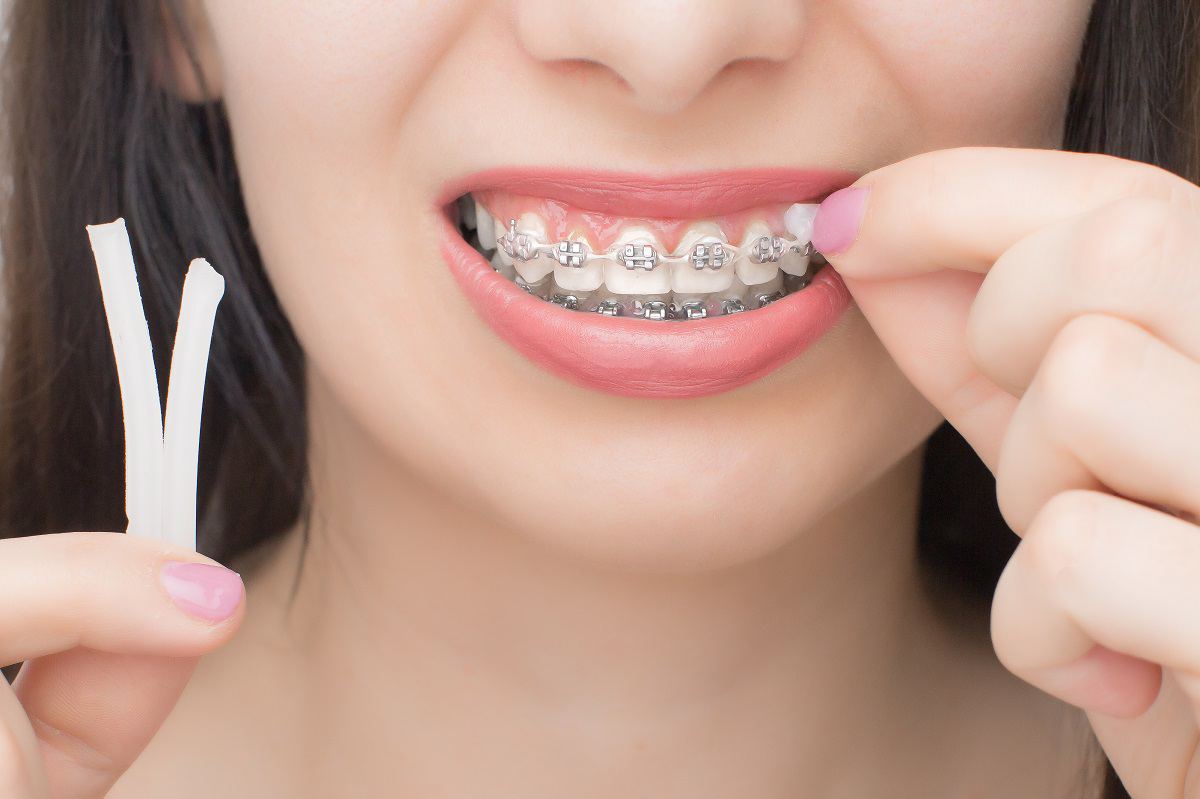 Cera para brackets