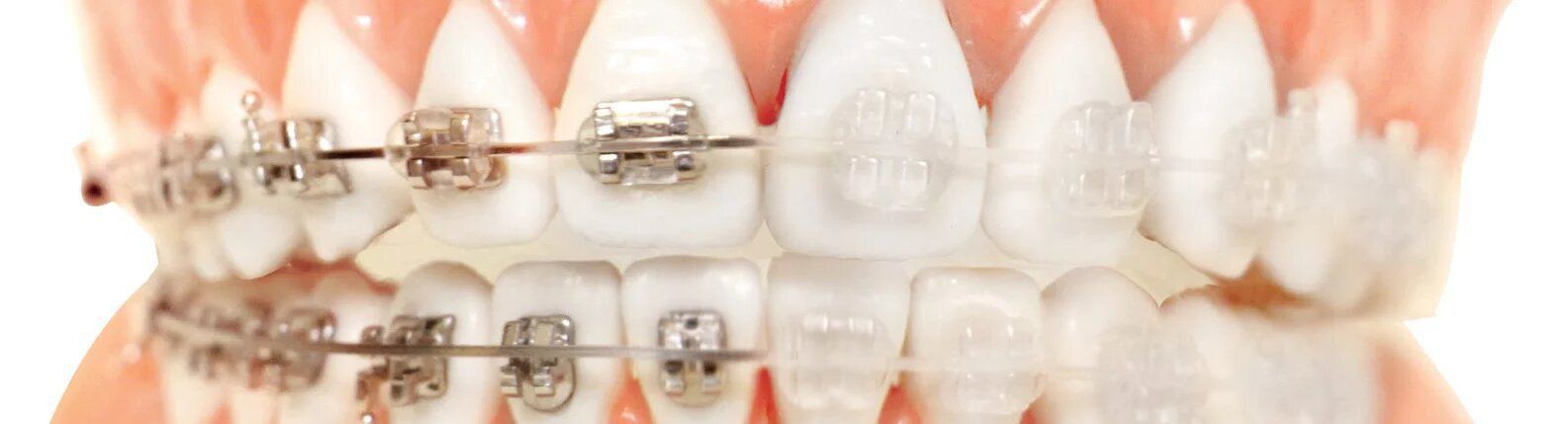 Brackets de zafiro