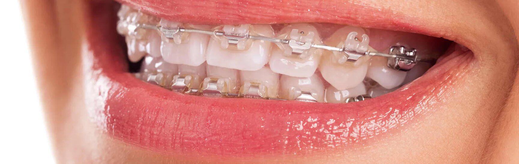 Brackets cerámicos