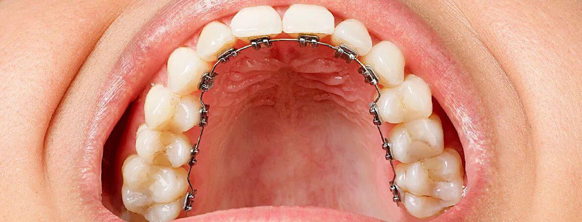 Brackets linguales