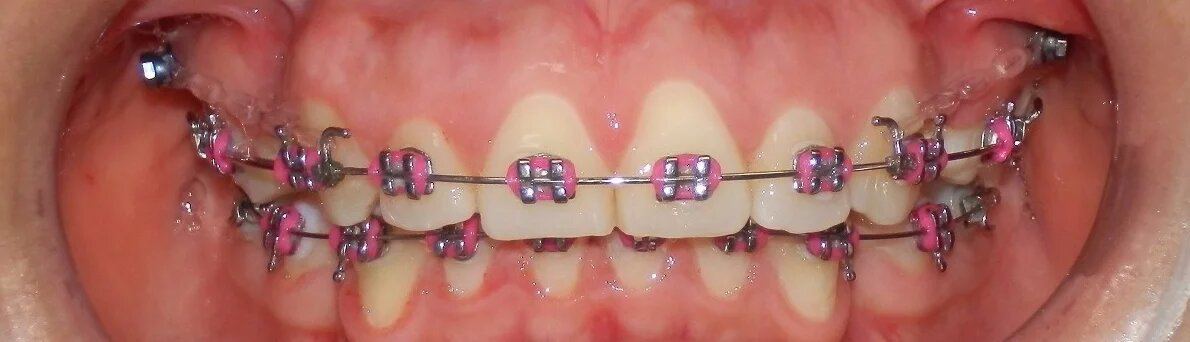 Brackets metálicos