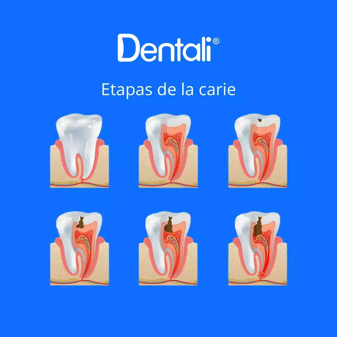 ¿Cómo saber si tengo caries?